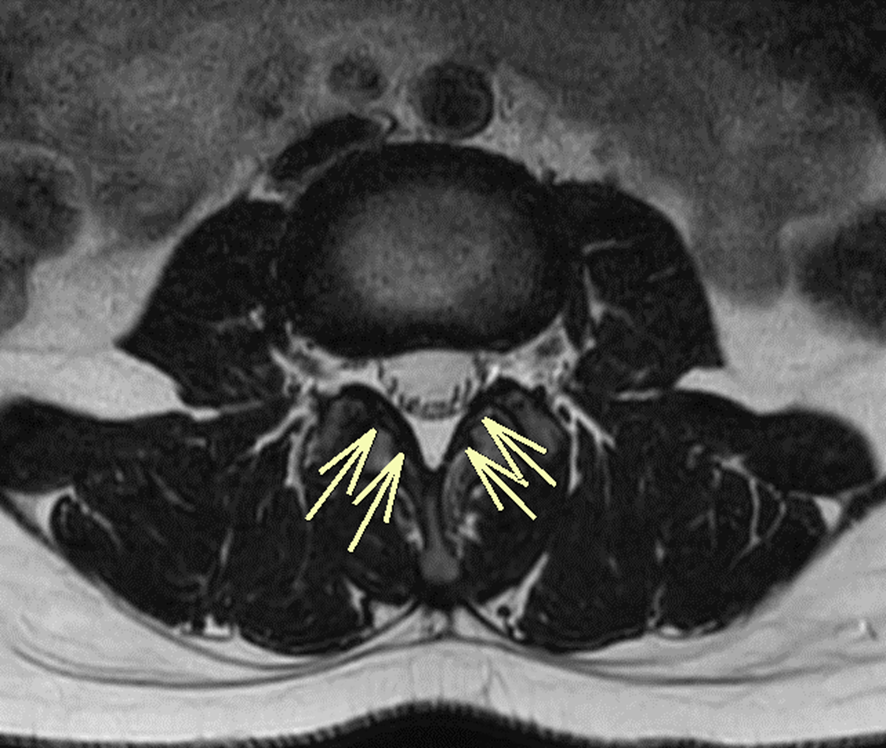 椎体MRI-黄色靱帯骨化症