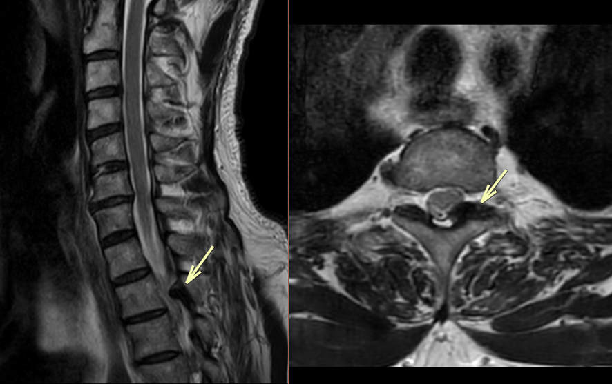 頚椎MRI-黄色靱帯骨化症