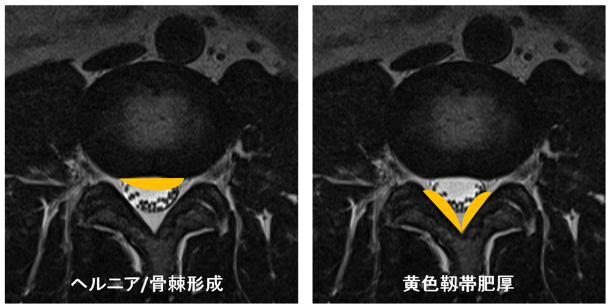 椎体MRI-骨棘形成 黄色靱帯肥厚症