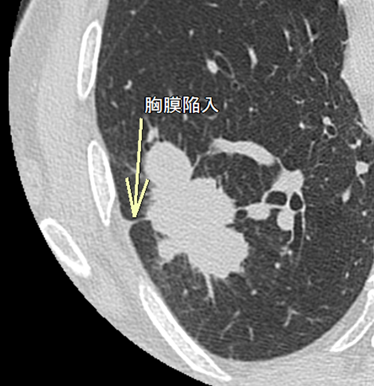 胸部CT-胸膜陥入