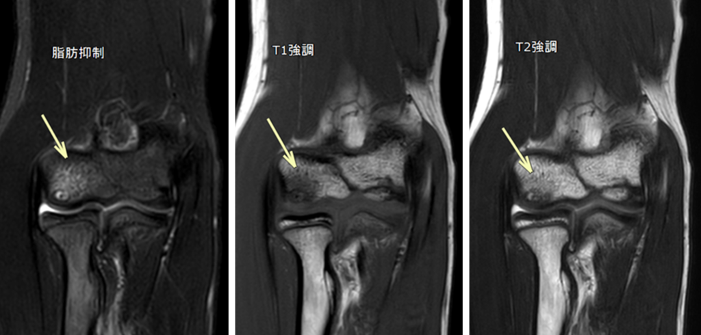 肘MRI-離断性骨軟骨炎