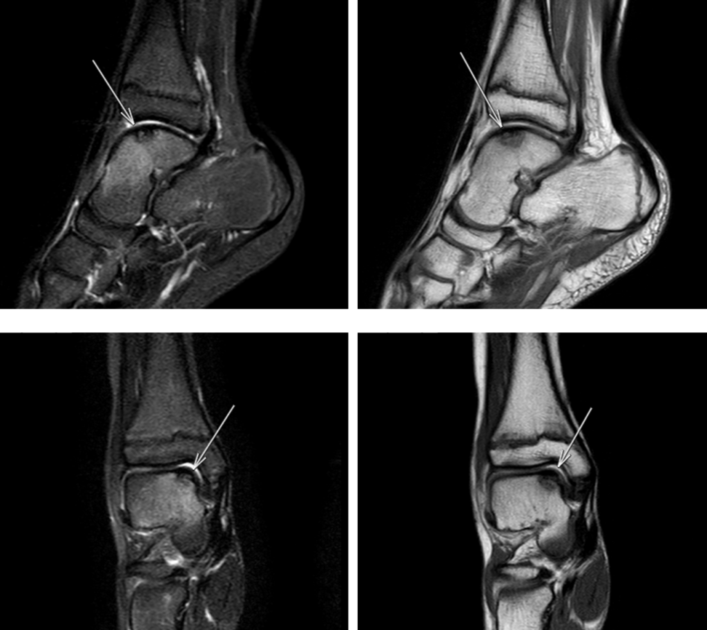 足MRI-離断性骨軟骨炎