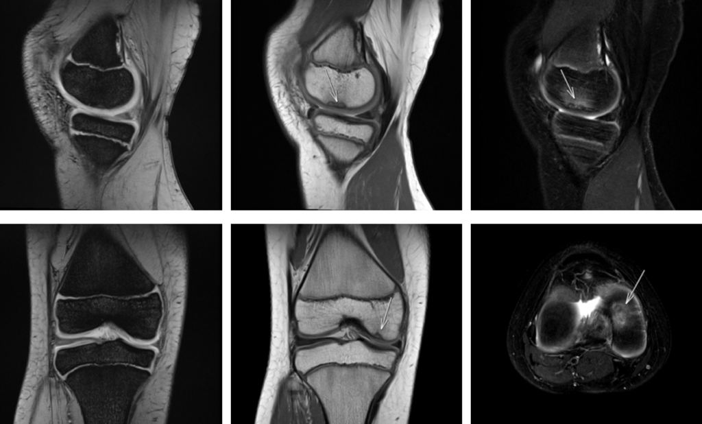 膝MRI-離断性骨軟骨炎