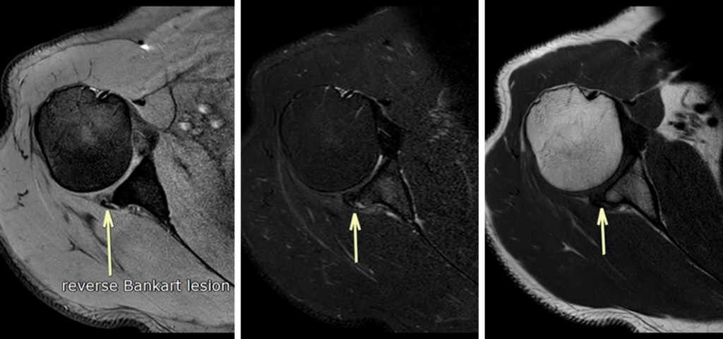 肩MRI-reverse-bankart-lesion