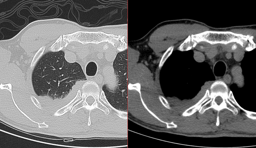 胸部CT-Pancoast腫瘍