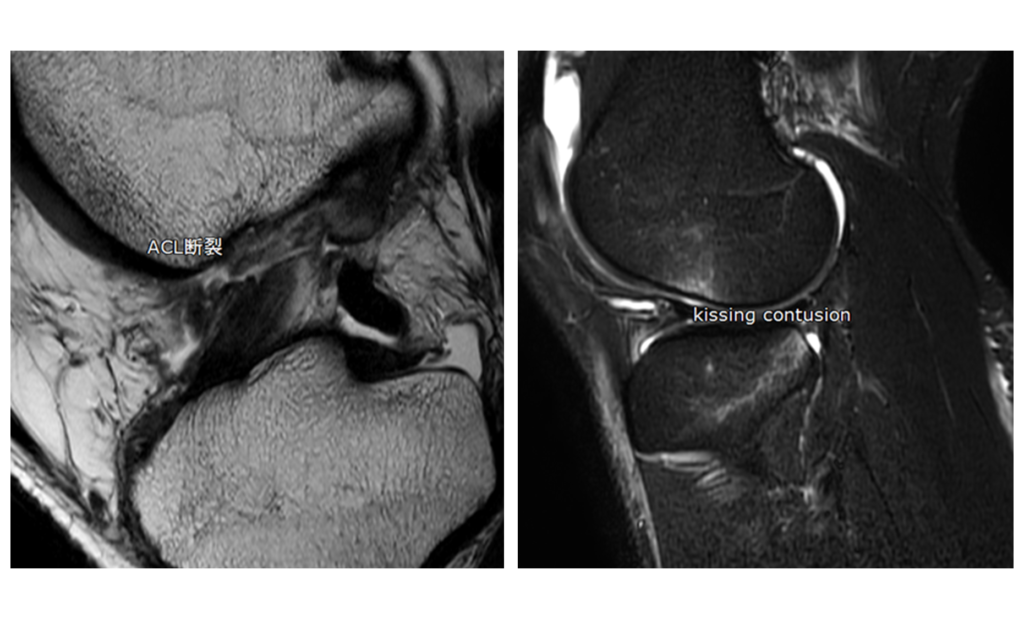 膝MRI-kissing-contusion