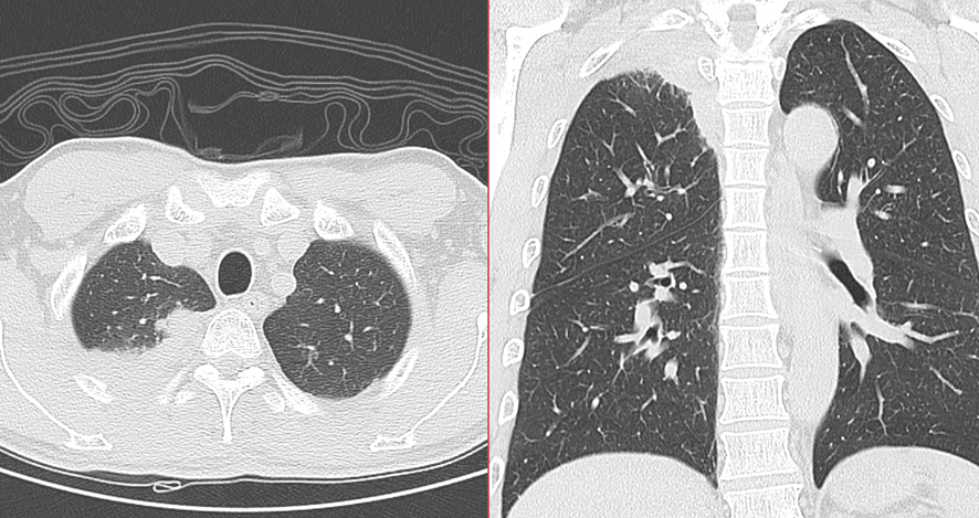 胸部CT-Pancoast腫瘍