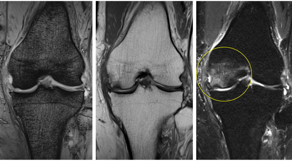 膝MRI-大腿骨内顆特発性骨壊死