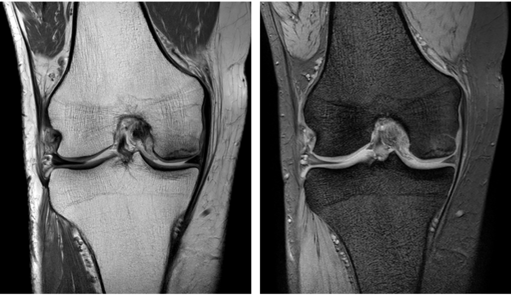 膝MRI-大腿骨内顆特発性骨壊死