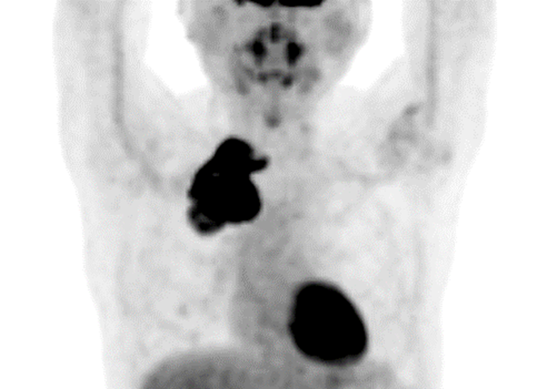 FDG-PET-Pancoast腫瘍