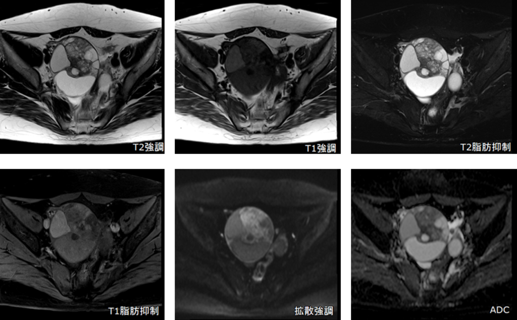骨盤MRI-卵巣癌