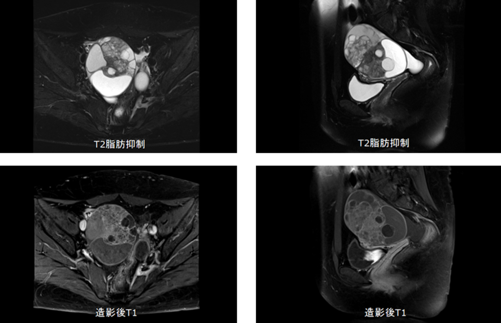 骨盤MRI-卵巣癌
