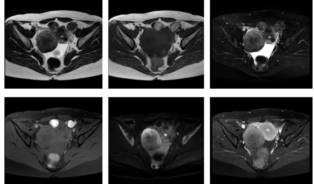 骨盤MRI-卵巣線維腫