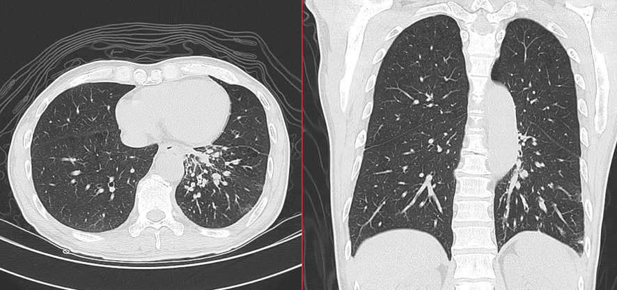 胸部CT-癌性リンパ管症