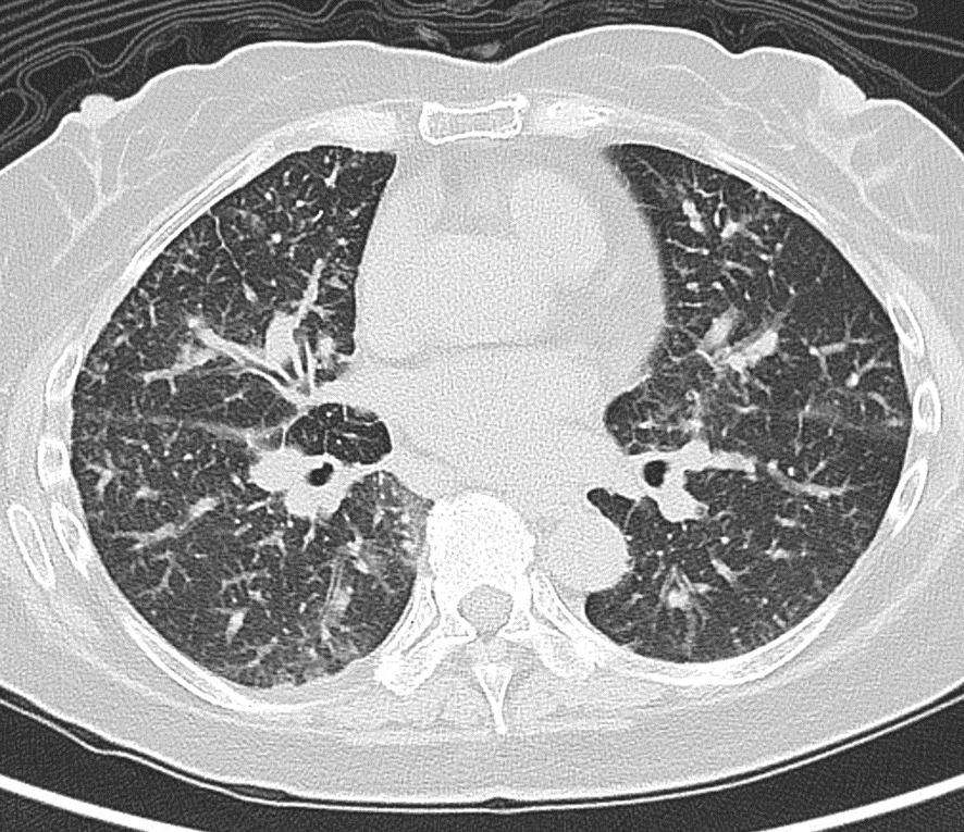 胸部CT-癌性リンパ管症