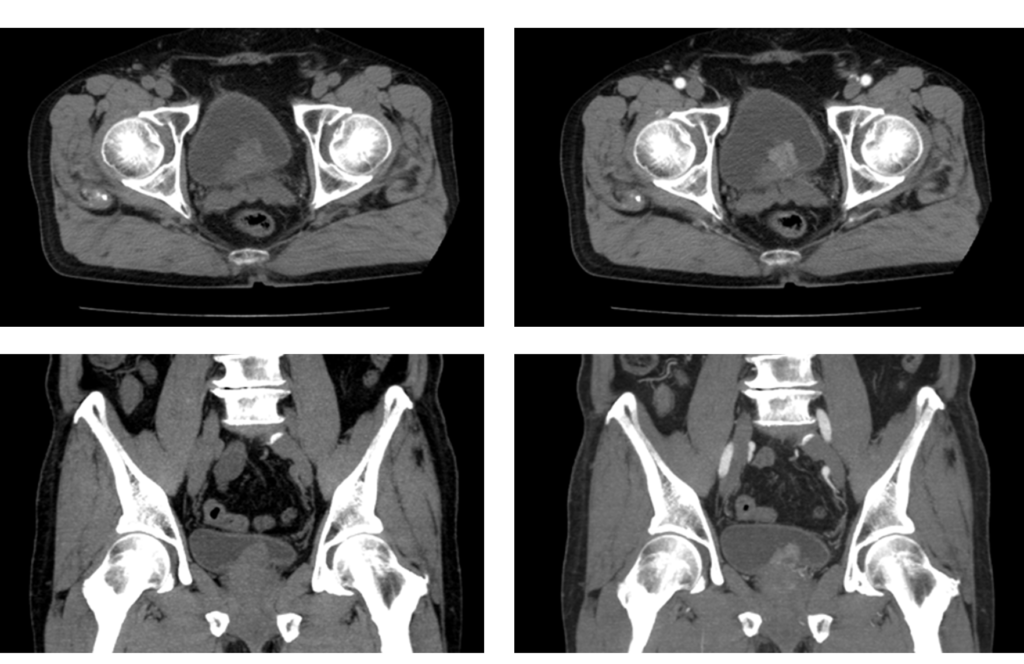 骨盤CT-膀胱癌