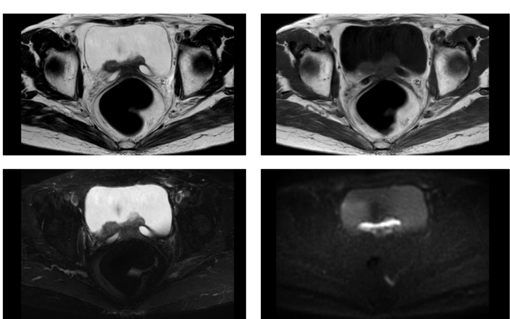 骨盤MRI-膀胱癌