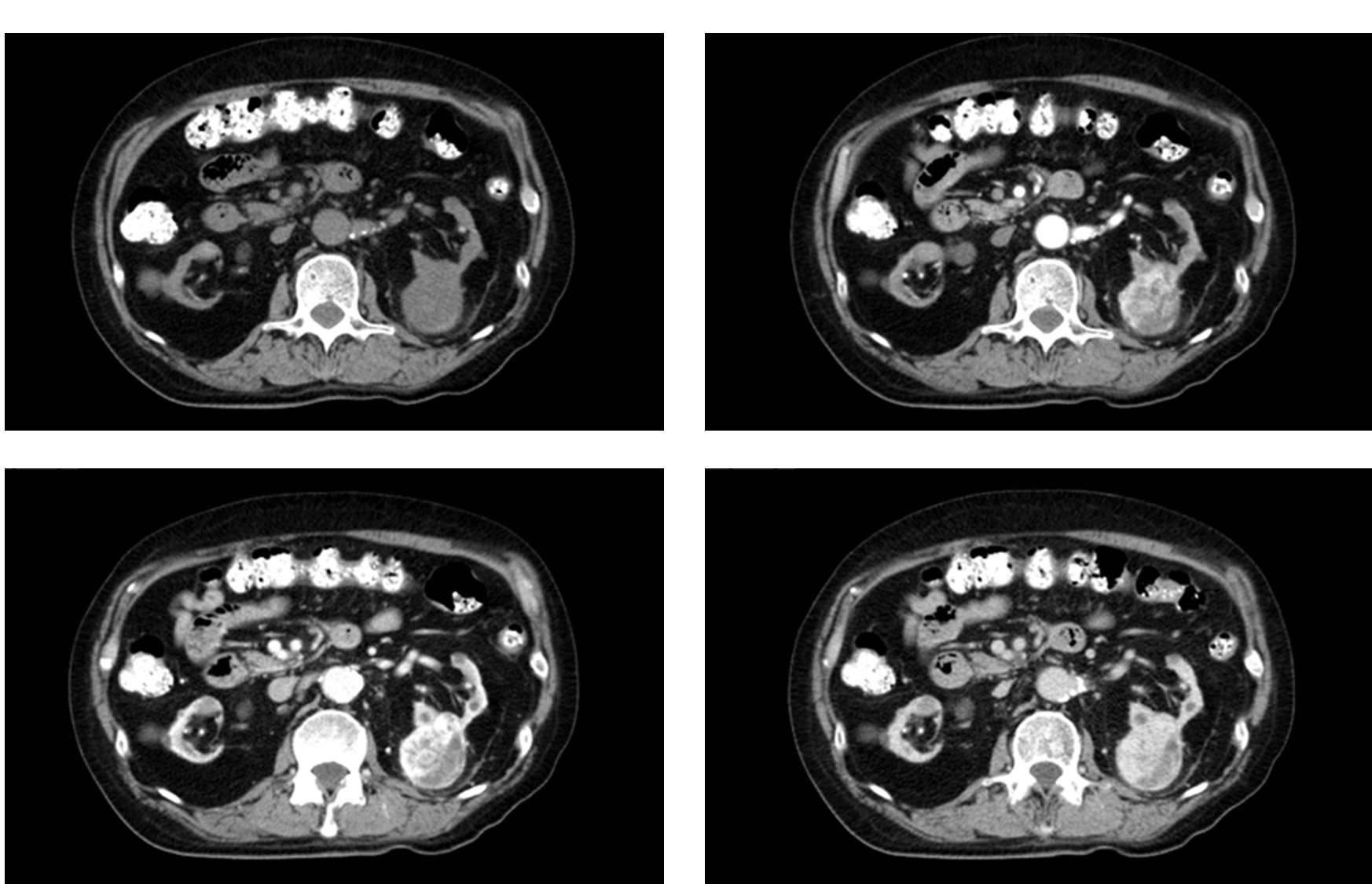腎細胞癌(renal cell carcinoma)
