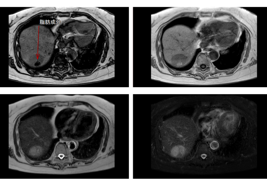 HCC　MRI画像