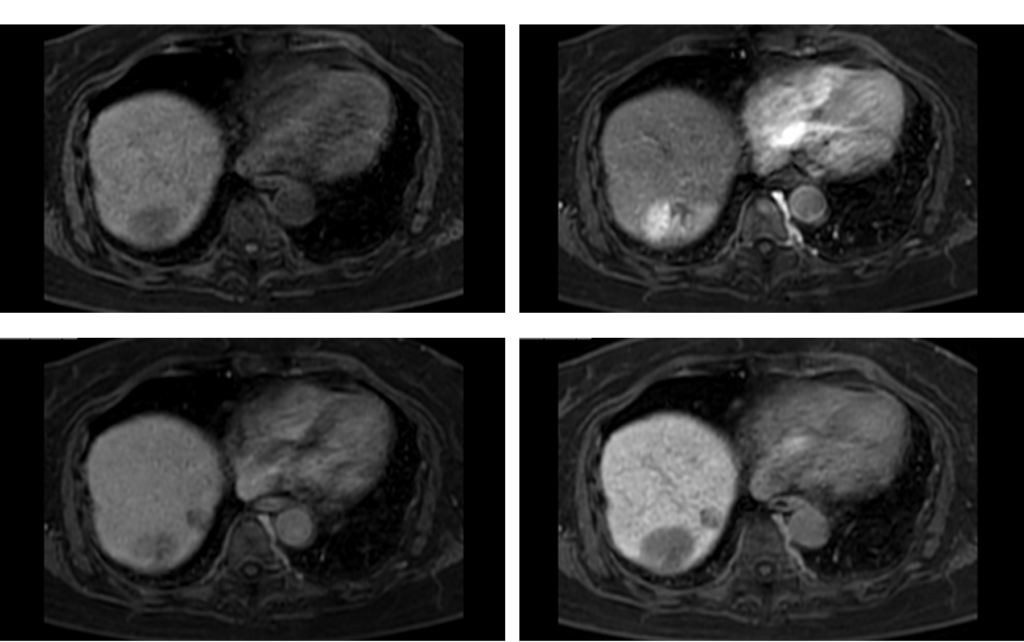 HCC　MRI画像