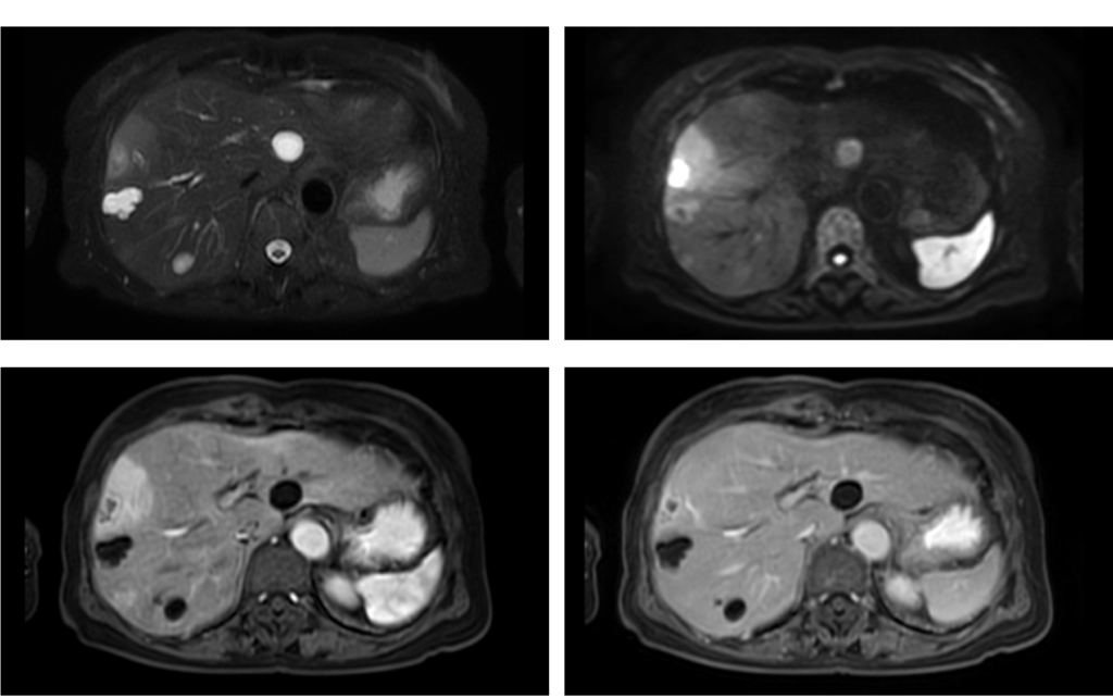腹部MRI-肝膿瘍