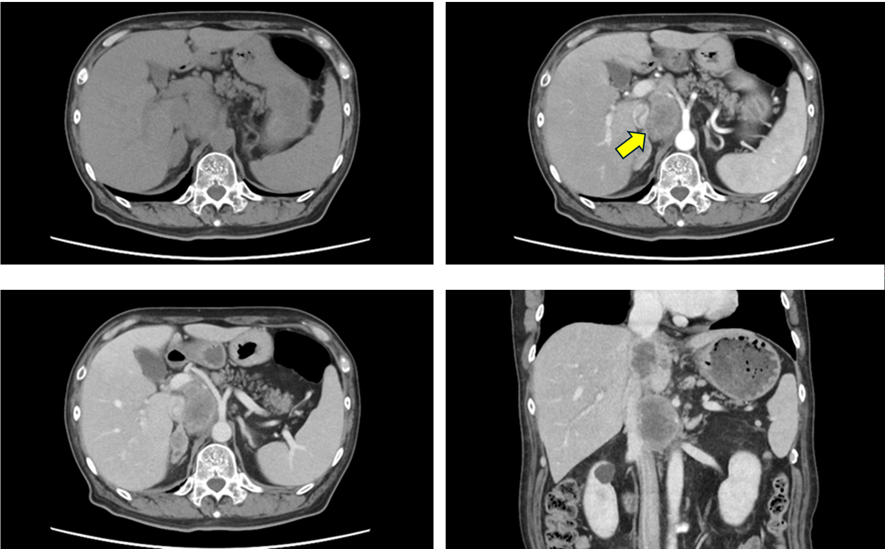 胆管癌（cholangiocarcinoma）