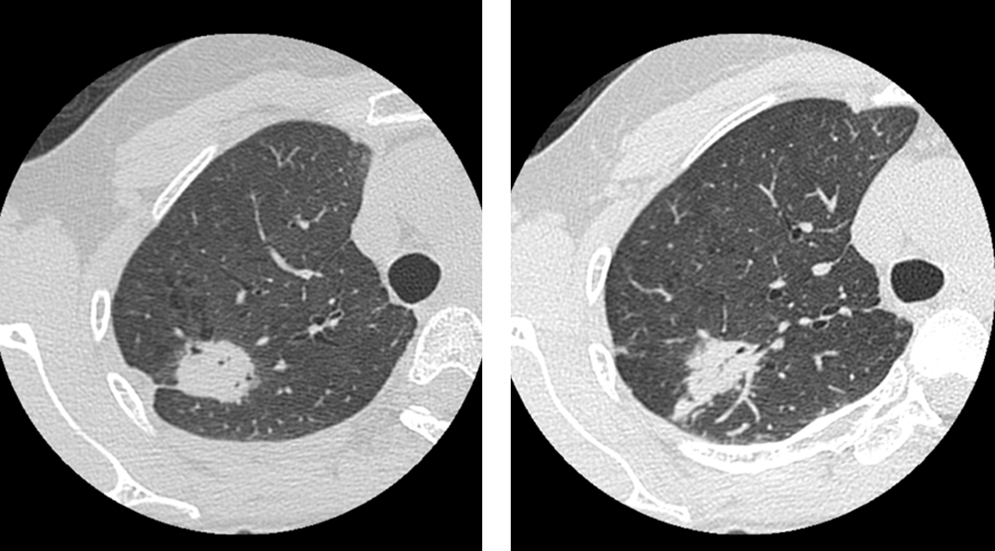 肺癌(lung cancer)
