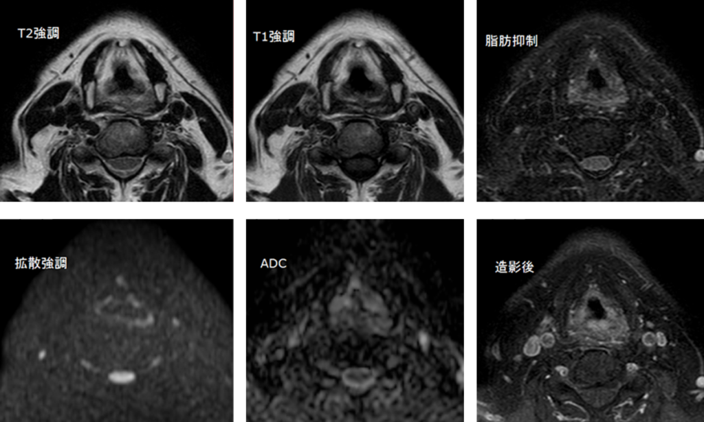 頸部MRI-下咽頭癌