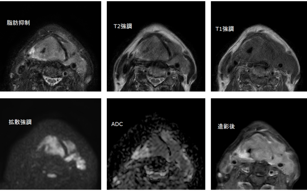 頸部MRI-下咽頭癌