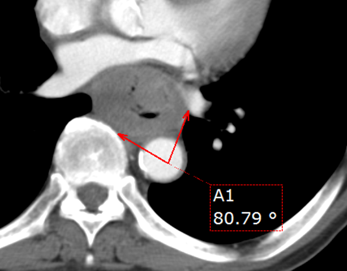 胸部CT-食道癌