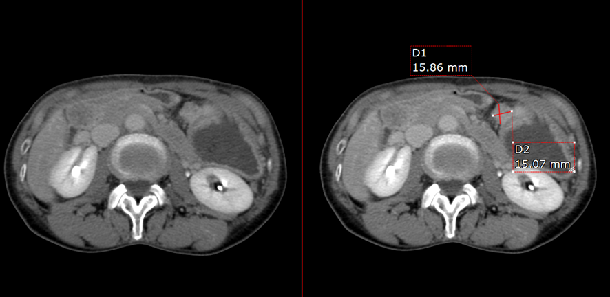 腹部CT-胃癌