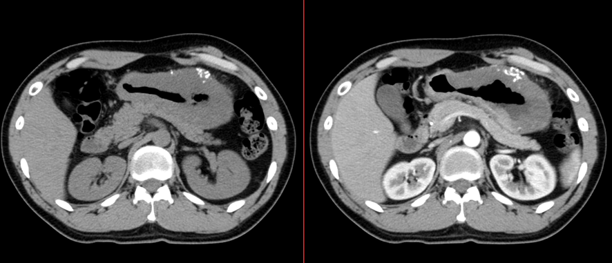 腹部CT-スキルス胃癌