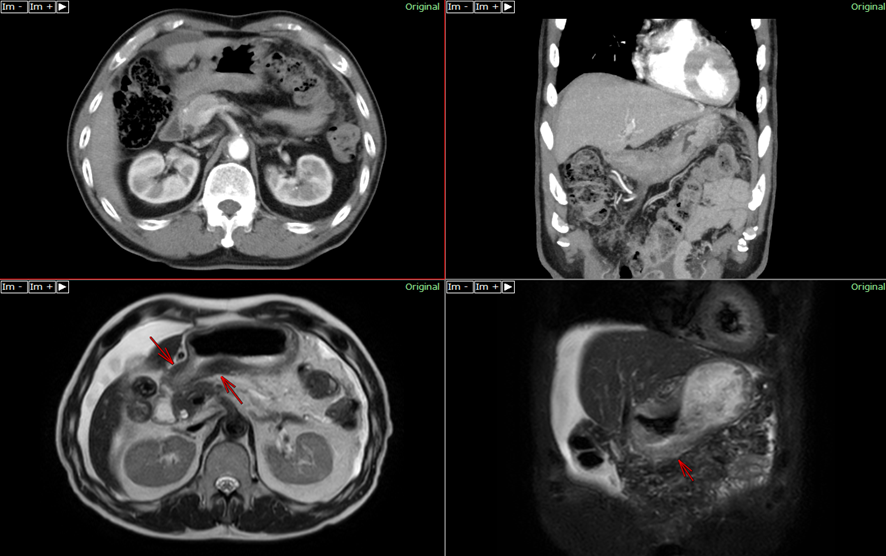 腹部CT／MRI-胃癌