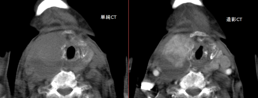 頸部CT-甲状腺癌