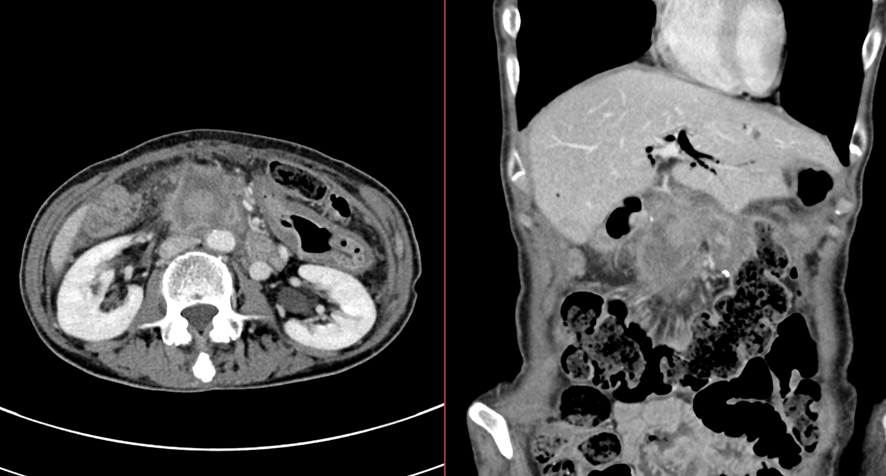 腹部CT-十二指腸癌