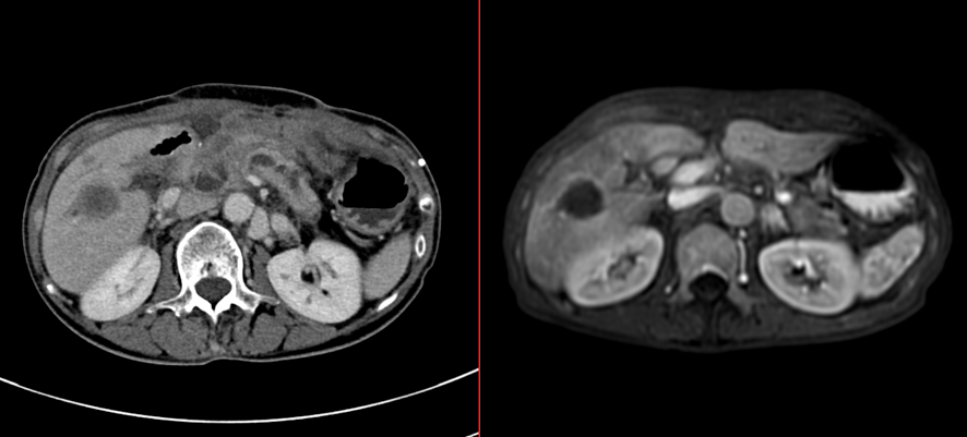 腹部CT/MRI-十二指腸癌