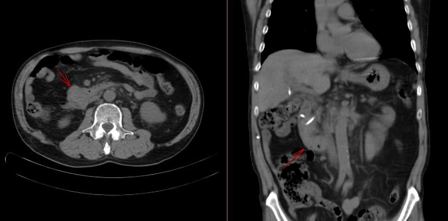 腹部CT-十二指腸癌