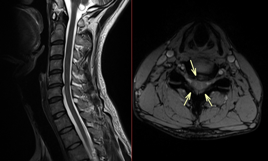 頚椎MRI-脊柱管狭窄症