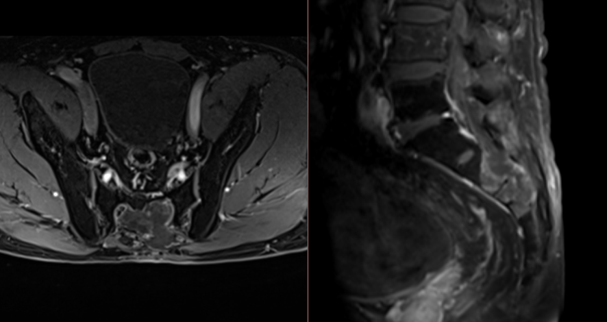 腰椎造影MRI-脊索腫