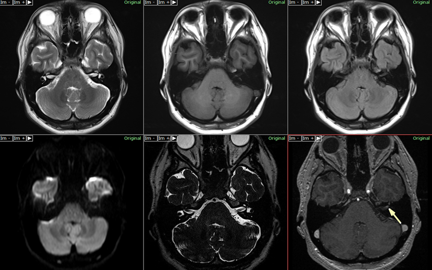 頭部MRI-ベル麻痺