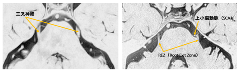 三叉神経痛(trigeminal neuralgia)