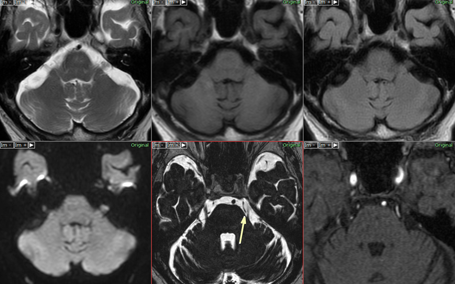 頭部MRI- 三叉神経痛3