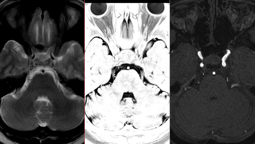 頭部MRI-三叉神経痛2