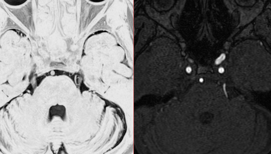 頭部MRI-三叉神経痛