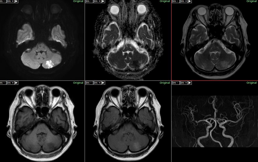 頭部MRI-小脳梗塞