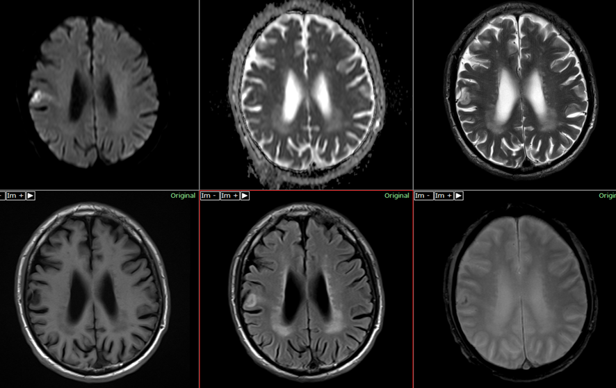 頭部MRI-脳梗塞2