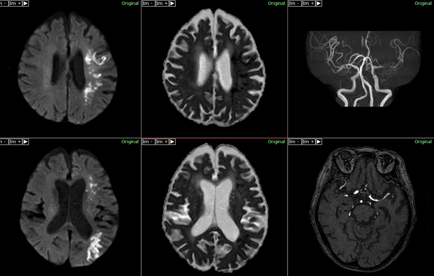 頭部MRI-脳梗塞