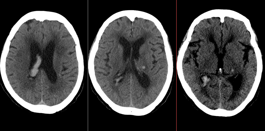 頭部CT-脳出血（脳室穿破）