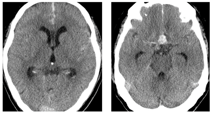 頭部CT-脳出血（くも膜下出血）