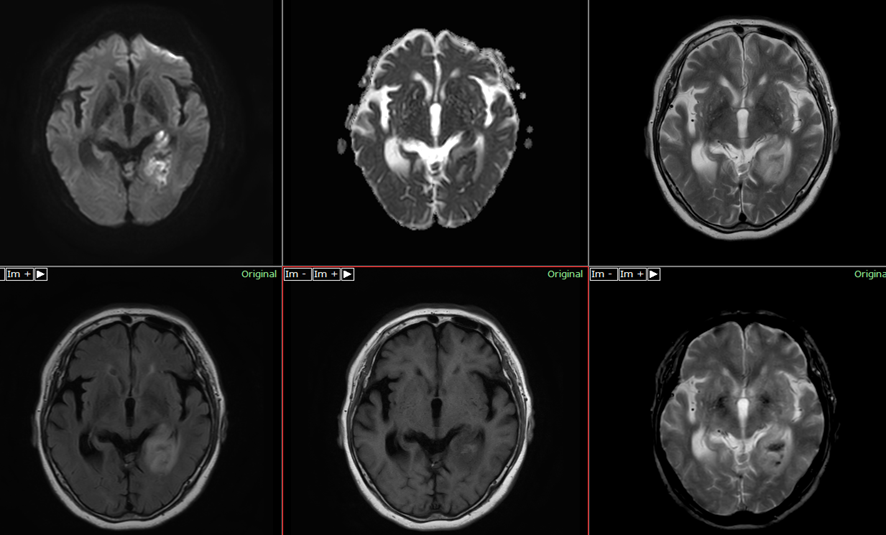 頭部MRI-脳出血2